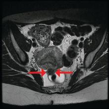 This patient's MRI shows a smaller rectosigmoid endometriotic nodule that was removed through a discoid resection.